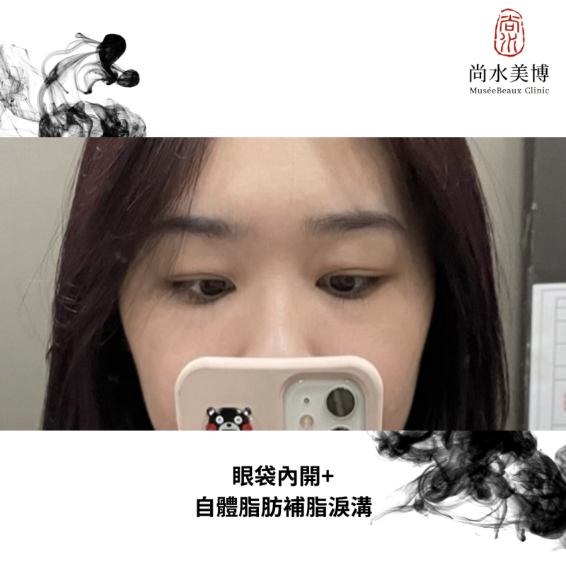 尚水美博心得評價｜眼袋內開+淚溝填補，拒絕跟遺傳性眼袋妥協